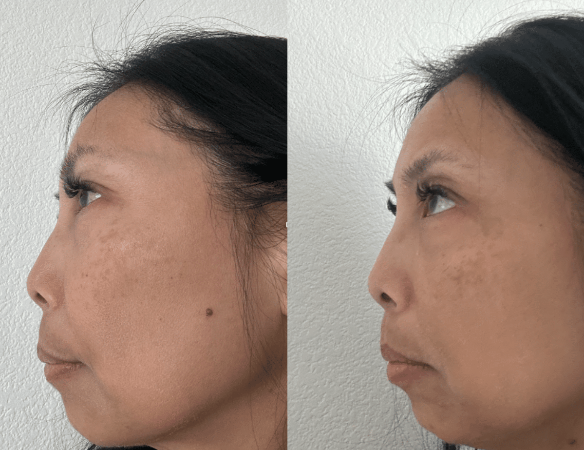 Tackling Hyperpigmentation: What Are Your Options?